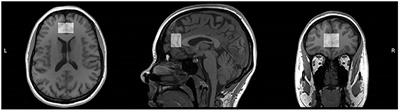 Decreased Medial Prefrontal Cortex Glutamate Levels in Perimenopausal Women